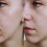 Limpiador Anti Acne Soy Canna Bella 100 ML (3.38 OZ) - Soy Cannabella