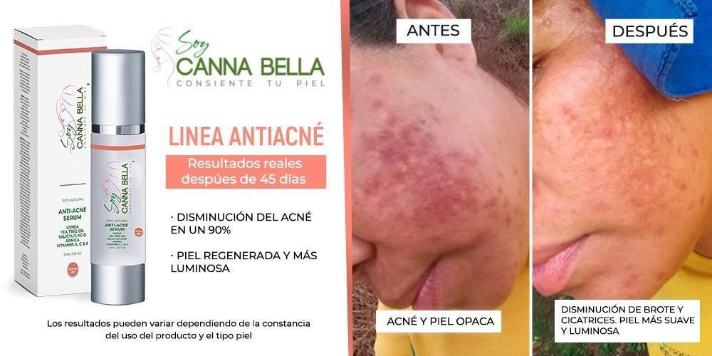 Set Anti-Acne PRO COMPLETO - Soy Cannabella
