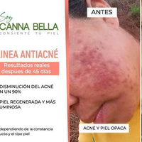 Set Anti-Acne PRO COMPLETO - Soy Cannabella